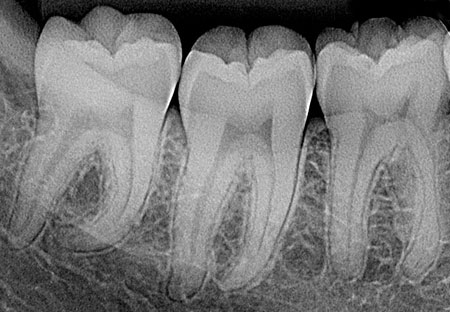 periapical